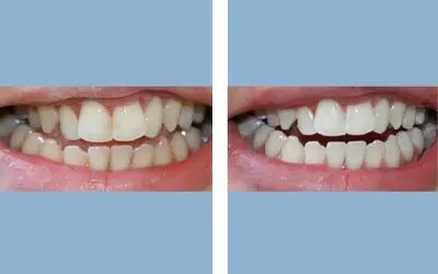 Before and After